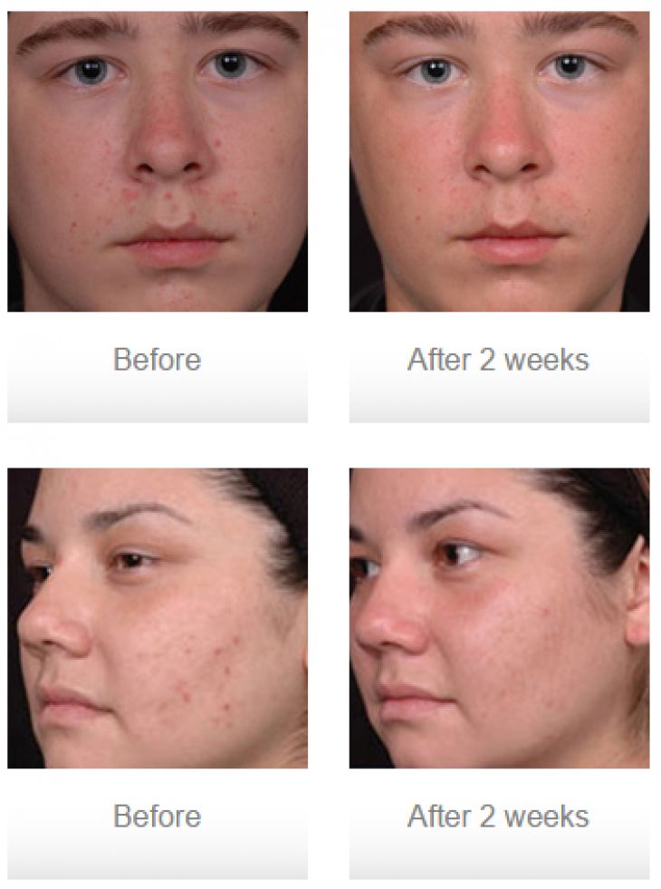 Acne Treatment before and after