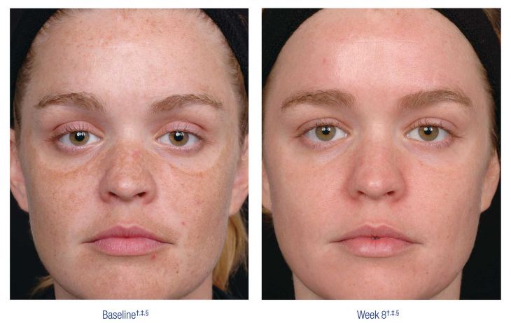 Nu Derm Before and After