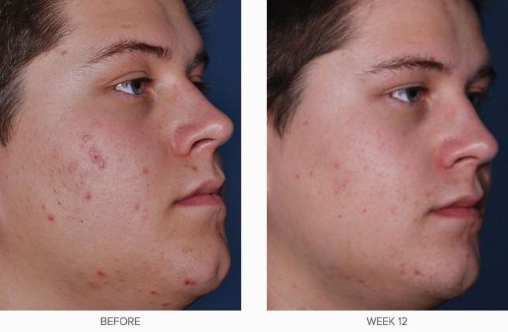 CLENZIderm M.D. Before & After