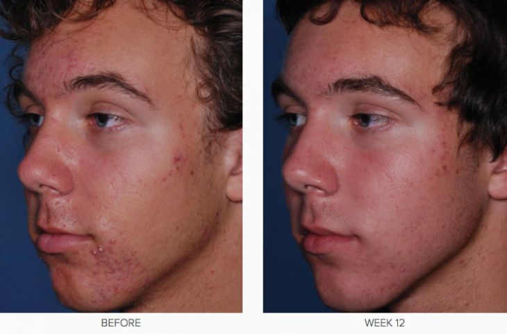 CLENZIderm M.D. Before & After