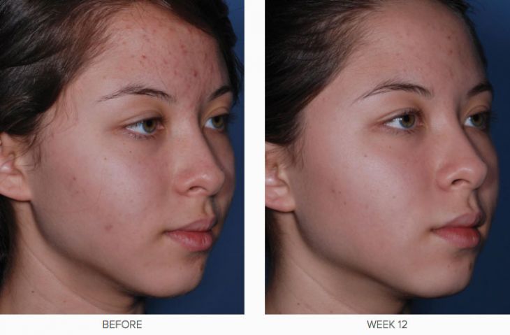 CLENZIderm M.D. Before & After