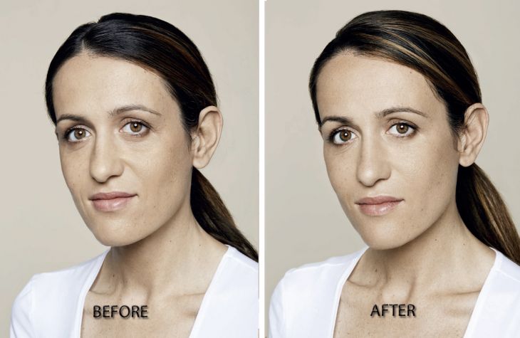 Restylance Skin Booster before and after treatment